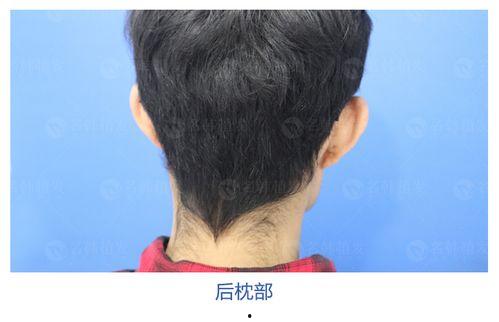 男明星植发图,男明星焕发新生，揭秘植发奇迹